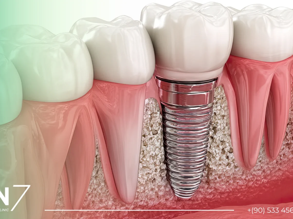 diş implantı
