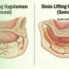sinüs lifting