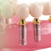 zigomatik implant