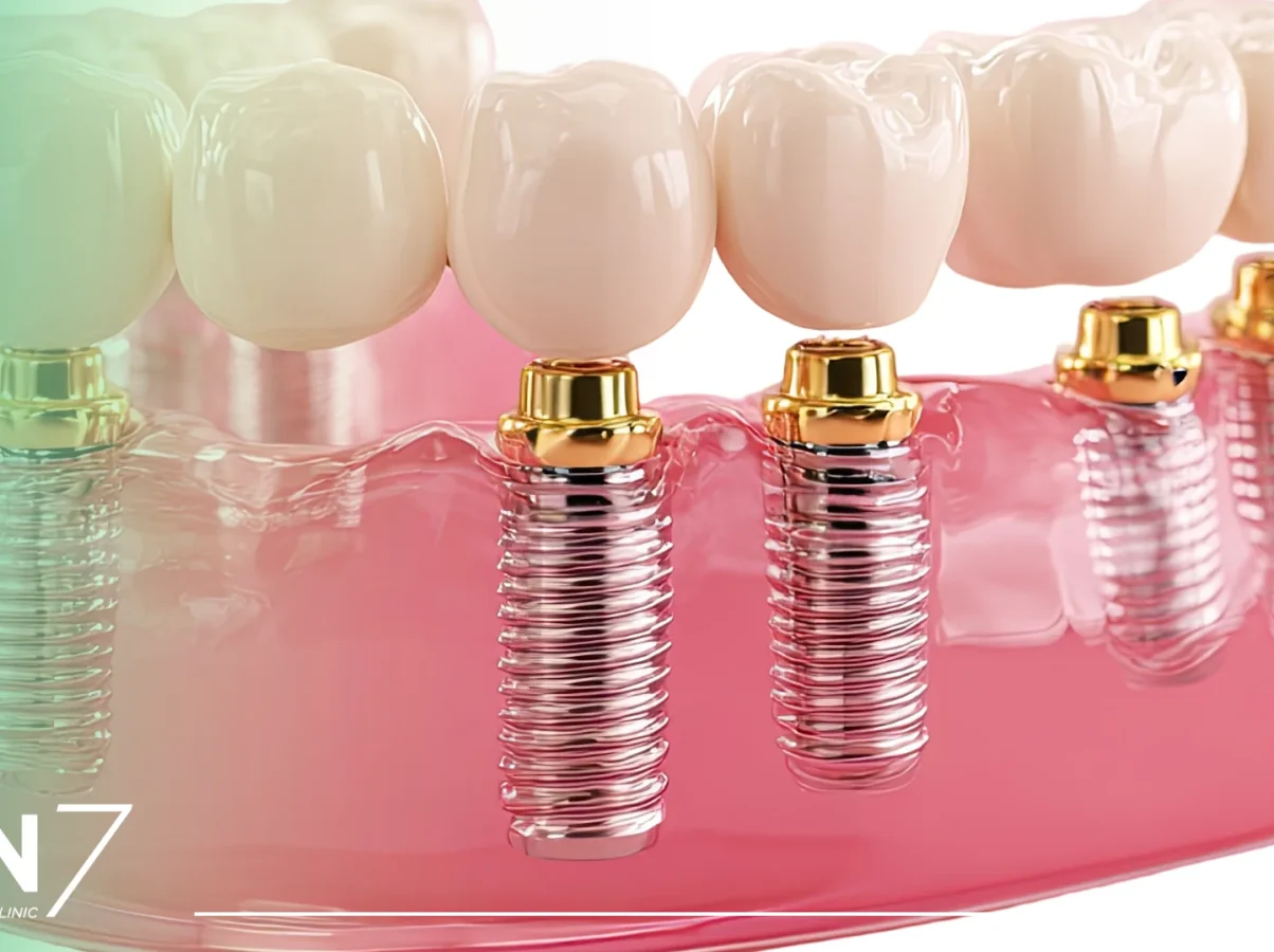 zigomatik implant