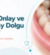 inlay-onlay-ve-overlay-dolgu-nedir inlay-onlay-ve-overlay-dolgu-nedir