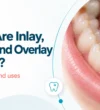 what-are-inlay-onlay-and-overlay-filling what-are-inlay-onlay-and-overlay-filling